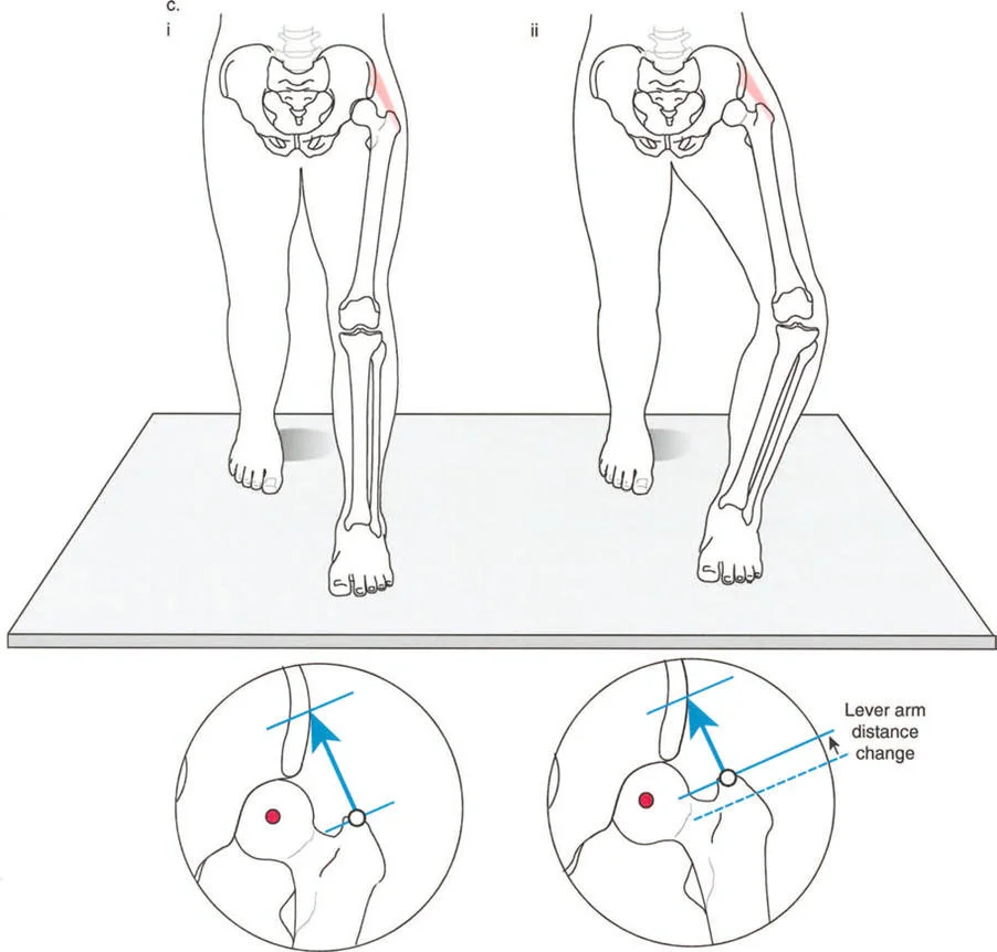 صورة توضح تأثير التشوه على الكاحل