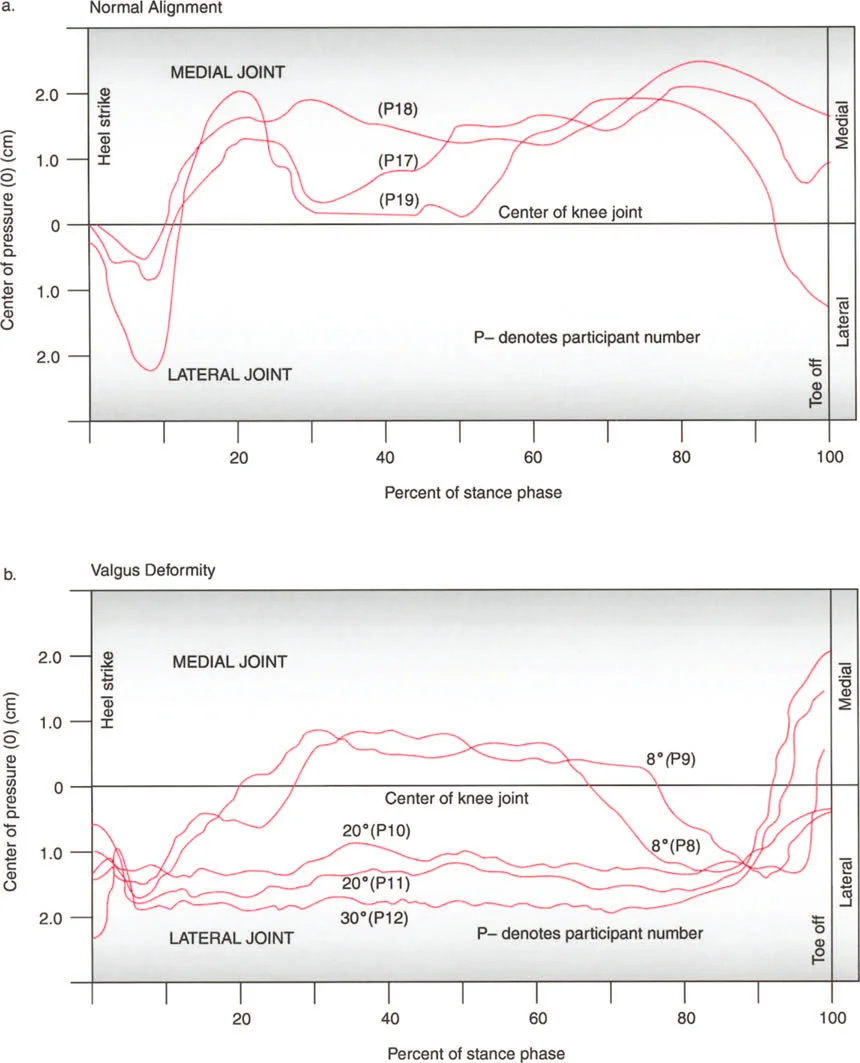 صورة توضح تحميل مفصل الكاحل غير الطبيعي