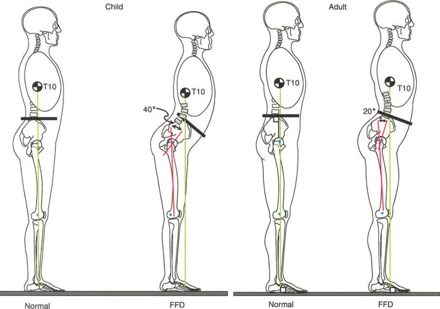صورة توضيحية لـ إتقان ميكانيكا المشي العظمية: دليل شامل لتصحيح التشوهات الديناميكية مع الأستاذ الدكتور محمد هطيف