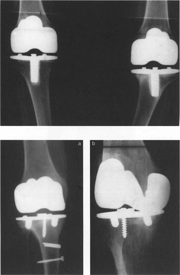 صورة طبية: فهم وعلاج التشوهات الديناميكية وخلل ميكانيكا الأذرع الرافعة في جراحة العظام مع الأستاذ الدكتور محمد هطيف