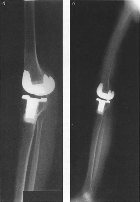 صورة طبية: فهم وعلاج التشوهات الديناميكية وخلل ميكانيكا الأذرع الرافعة في جراحة العظام مع الأستاذ الدكتور محمد هطيف