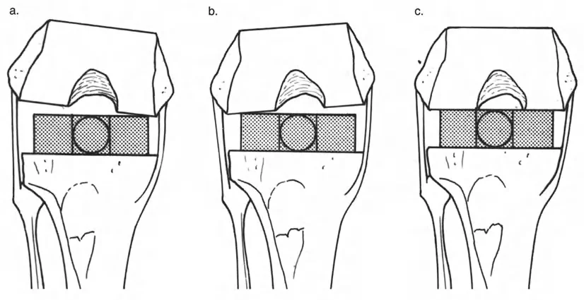صورة طبية: فهم وعلاج التشوهات الديناميكية وخلل ميكانيكا الأذرع الرافعة في جراحة العظام مع الأستاذ الدكتور محمد هطيف