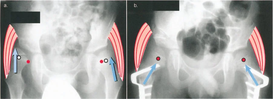 صورة طبية: فهم وعلاج التشوهات الديناميكية وخلل ميكانيكا الأذرع الرافعة في جراحة العظام مع الأستاذ الدكتور محمد هطيف