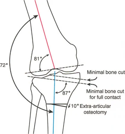 صورة طبية: فهم وعلاج التشوهات الديناميكية وخلل ميكانيكا الأذرع الرافعة في جراحة العظام مع الأستاذ الدكتور محمد هطيف