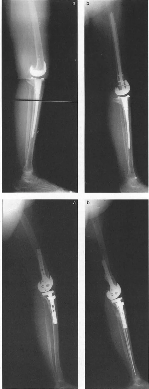 صورة طبية: فهم وعلاج التشوهات الديناميكية وخلل ميكانيكا الأذرع الرافعة في جراحة العظام مع الأستاذ الدكتور محمد هطيف