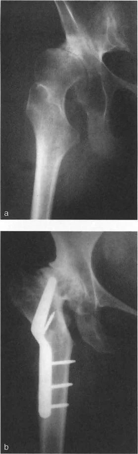 صورة توضيحية لـ استبدال مفصل الركبة والورك المعقد في حالات التشوه الشديد: دليل المريض الشامل
