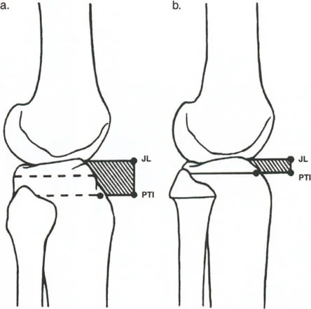 استبدال مفصل الركبة والورك المعقد في حالات التشوه الشديد: دليل المريض الشامل