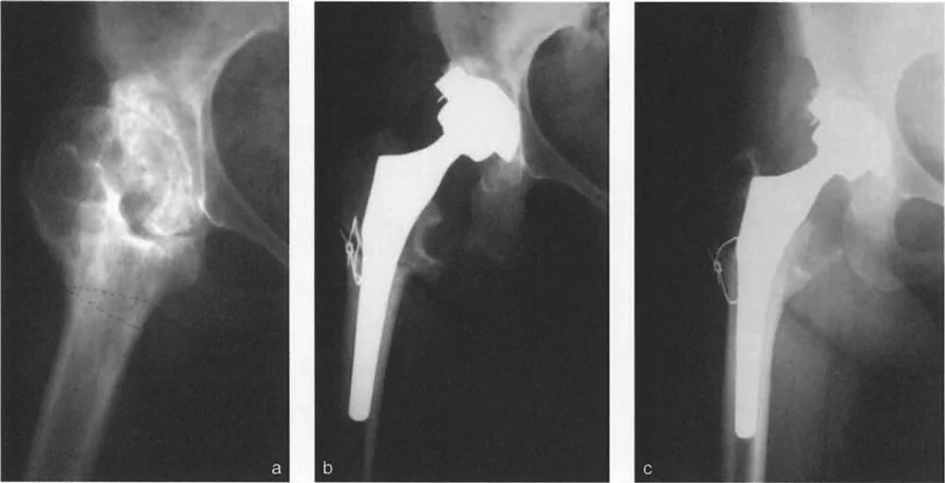 جراحة استبدال المفاصل المتقدمة في حالات التشوهات الشديدة: استعادة الحركة والراحة للركبة والورك