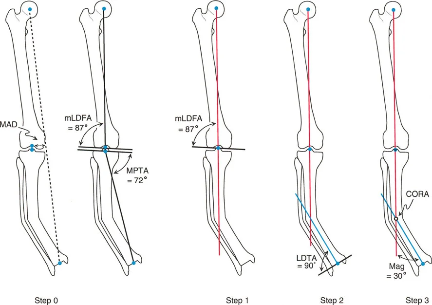 صورة توضيحية لـ تصحيح تشوهات الأطراف السفلية الكلي: دليل شامل للتخطيط الدقيق والعلاج المتقدم في صنعاء مع الأستاذ الدكتور محمد هطيف