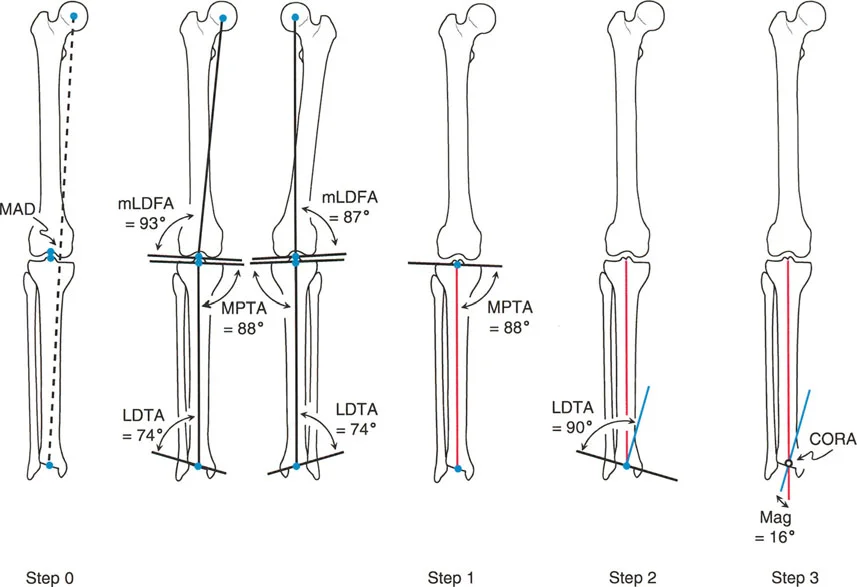 صورة توضيحية لـ تصحيح انحرافات الساقين والأطراف السفلية في صنعاء: دليل شامل مع الأستاذ الدكتور محمد هطيف