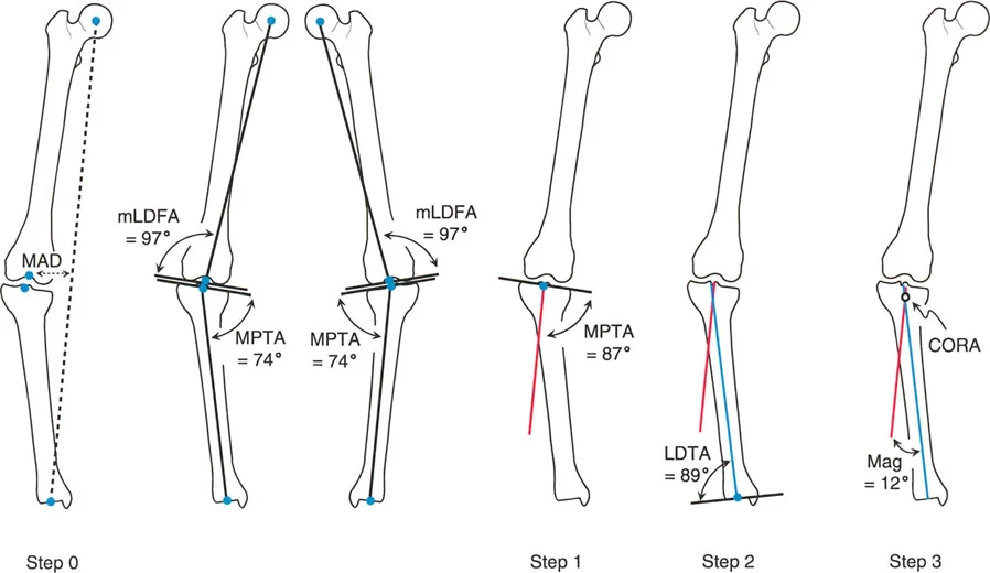 تصحيح انحرافات الساقين والأطراف السفلية في صنعاء: دليل شامل مع الأستاذ الدكتور محمد هطيف