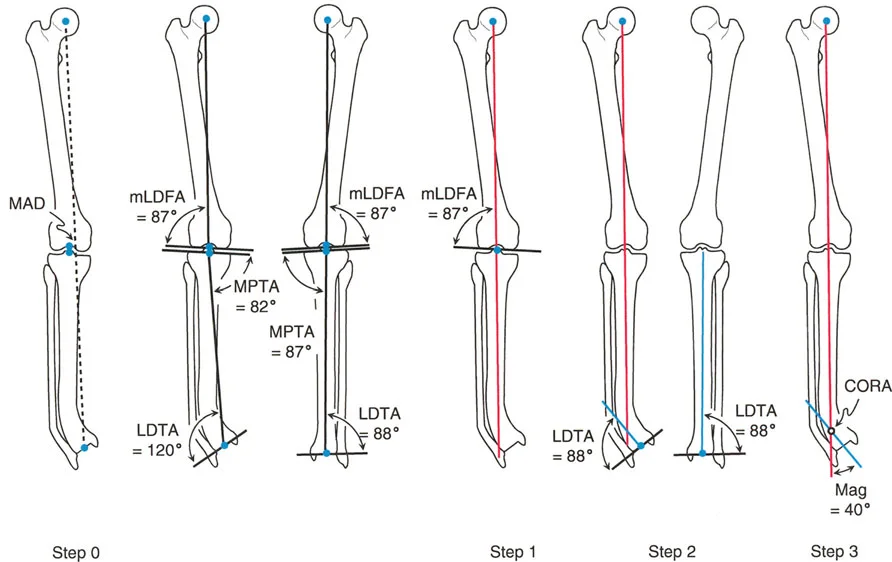 صورة توضيحية لـ تصحيح انحرافات الساقين والأطراف السفلية في صنعاء: دليل شامل مع الأستاذ الدكتور محمد هطيف