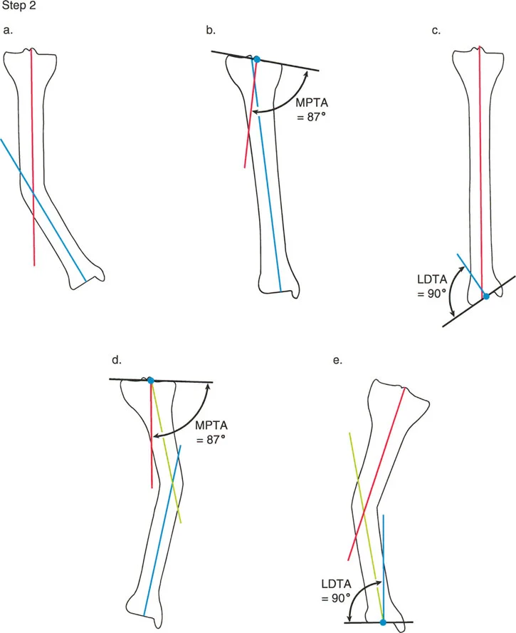 صورة توضيحية لـ تصحيح تشوهات عظام الساق والمحور الميكانيكي: دليل المريض الشامل