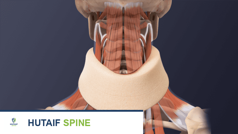 التعافي بعد جراحة دمج الفقرات العنقية الأمامي (ACDF): دليل شامل للأسبوعين الأولين وما بعدهما