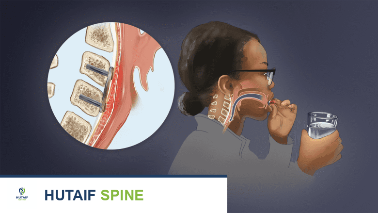 Illustration showing difficulty in swallowing.