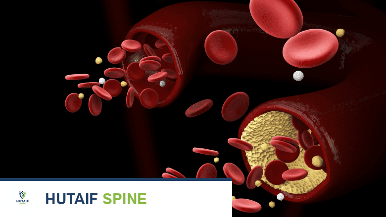 تمدد الأبهر البطني: الأسباب، عوامل الخطر، التشخيص والعلاج مع الأستاذ الدكتور محمد هطيف