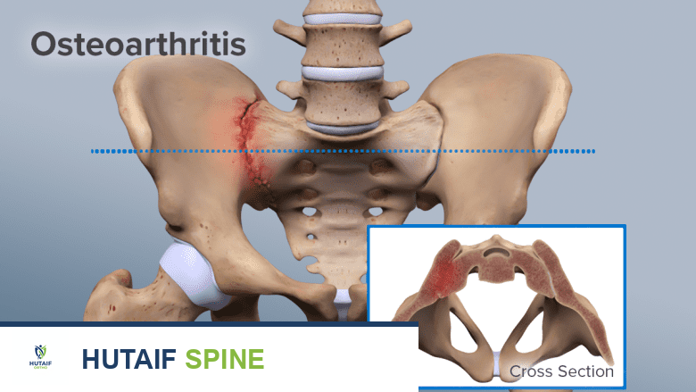 سيليبريكس (سيليكوكسيب): دليلك الشامل لمثبطات COX-2 وتخفيف آلام المفاصل