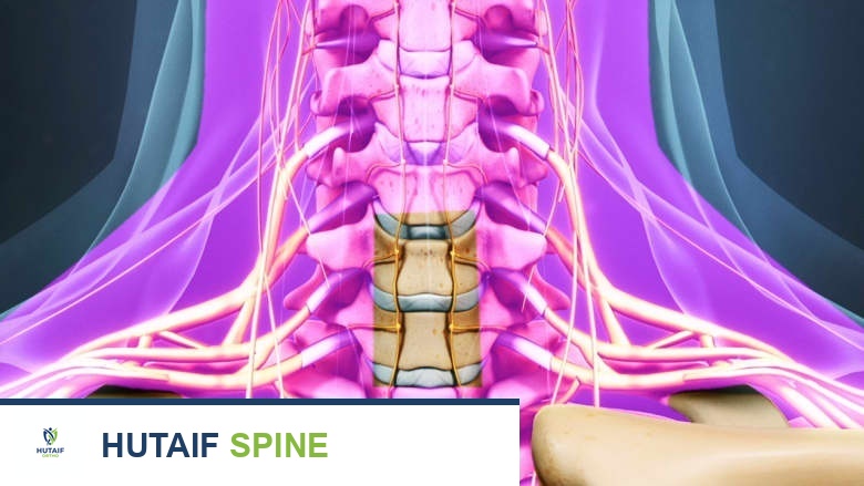 جراحة استئصال القرص العنقي الأمامي ودمج الفقرات (ACDF): حلول متقدمة لآلام الرقبة مع الأستاذ الدكتور محمد هطيف