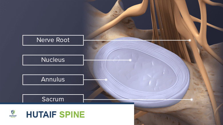 منظر علوي مُسمّى لقرص L5-S1 طبيعي.