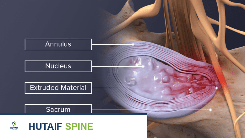 منظر علوي مُسمّى لقرص L5-S1 منزلق.