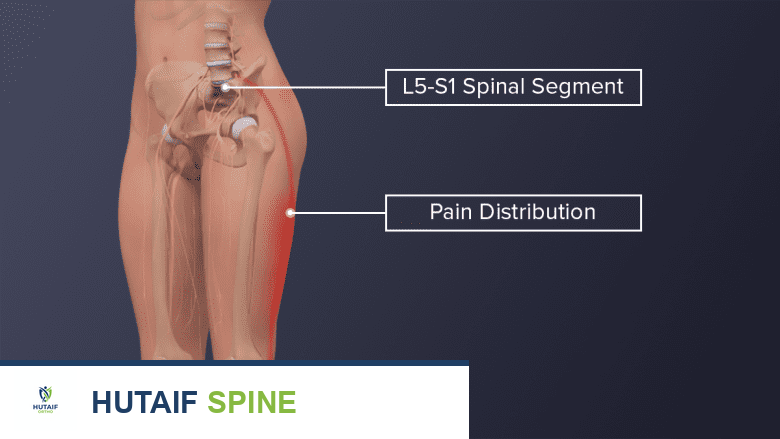 صورة منظر أمامي للجزء السفلي من الجسم والهيكل العظمي مع تسمية الجزء L5-S1 والألم الجذري المرتبط به.
