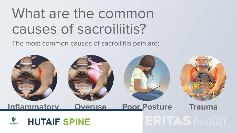 صورة طبية: التهاب المفصل العجزي الحرقفي كل ما تحتاج لمعرفته مع الأستاذ الدكتور محمد هطيف