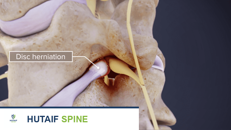 عرض سهمي لقرص عنقي منفتق يضغط على العصب