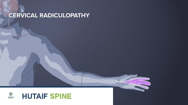 رسم توضيحي لألم اعتلال الجذور العنقية في اليد.