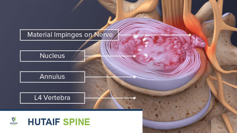 صورة طبية: كل ما تحتاج معرفته عن الفقرات القطنية L3-L4: دليل شامل لآلام الظهر وتشخيصها وعلاجها