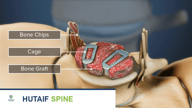 توضيح طبي: الطعوم العظمية الخيفية: كل ما تحتاج معرفته عن زراعة العظام من متبرع