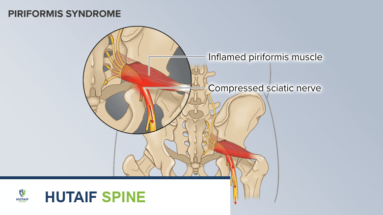يمكن أن تتشنج العضلة الكمثرية وتسبب الألم عند إصابتها أو التهابها