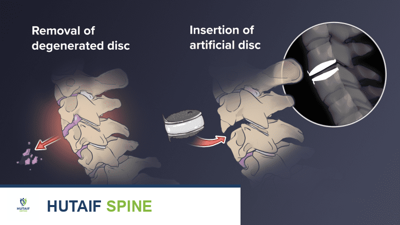 فك الضغط العنقي الأمامي ودمج الفقرات (ACDF): حل شامل لاعتلال النخاع الشوكي العنقي مع الأستاذ الدكتور محمد هطيف
