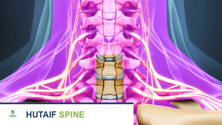 جراحة تخفيف الضغط ودمج الفقرات العنقية الأمامي (ACDF): دليلك الشامل مع الأستاذ الدكتور محمد هطيف في صنعاء