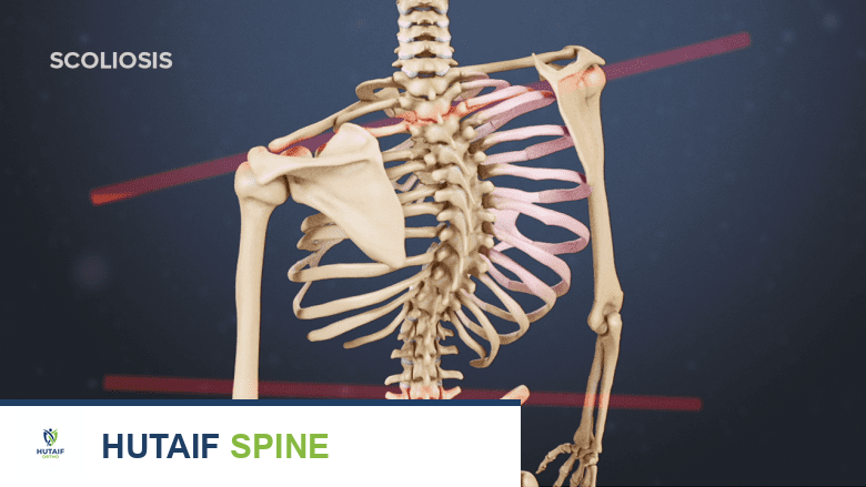 علاج آلام الظهر عند الأطفال والمراهقين: دليلك الشامل مع الأستاذ الدكتور محمد هطيف في صنعاء