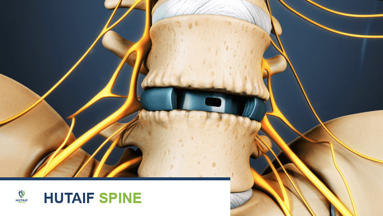 جراحة العمود الفقري القطني: دليل شامل لمرضى آلام الظهر والساقين مع الأستاذ الدكتور محمد هطيف