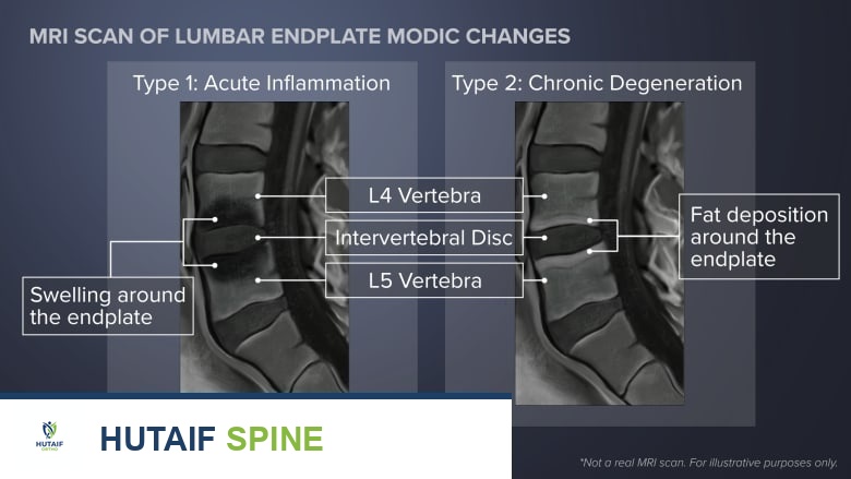 صورة توضيحية لـ كي العصب القاعدي الفقري: حل مبتكر وفعال لآلام أسفل الظهر المزمنة