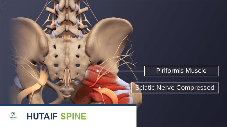 رسم توضيحي يظهر العصب الوركي مضغوطًا بسبب الضغط داخل العضلات.