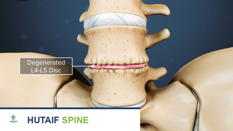 Illustration showing degeneration in the lumbar spine L4-L5.