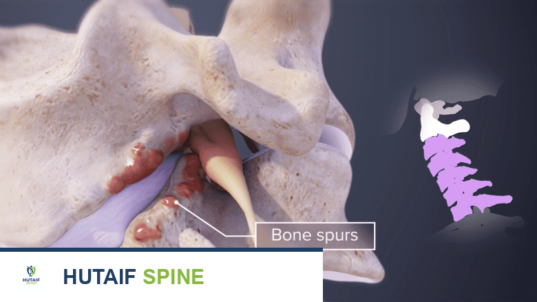 Illustration of cervical vertebra showing bone spurs and cervical spine highlighted in pink.