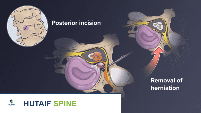 صورة توضيحية لـ دليلك الشامل لعلاج آلام ومشاكل فقرات الرقبة C2-C5 مع الأستاذ الدكتور محمد هطيف