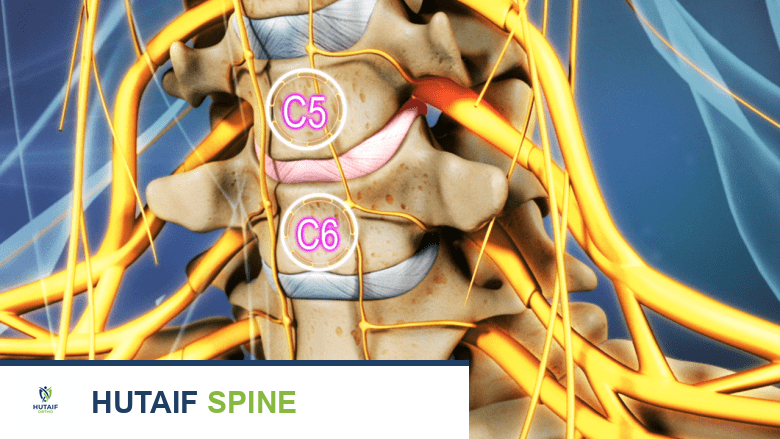 علاج فقرات C5-C6: دليلك الشامل لآلام الرقبة وتخفيف الضغط العصبي مع الأستاذ الدكتور محمد هطيف
