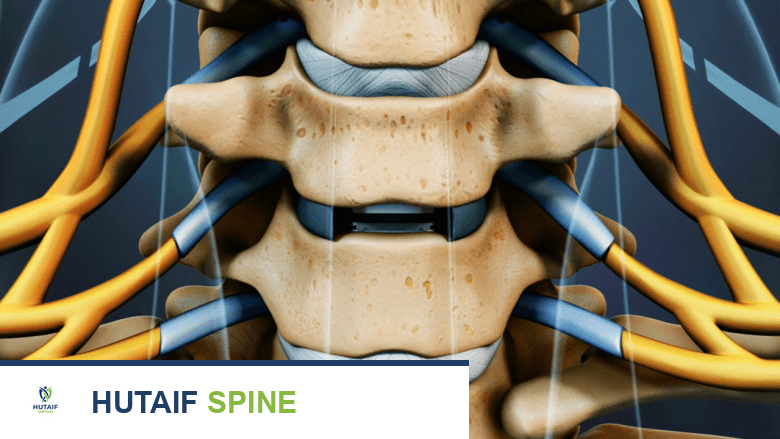 علاج الفقرات العنقية C6-C7: دليل شامل من الأستاذ الدكتور محمد هطيف في صنعاء