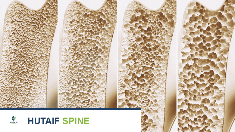 مراحل هشاشة العظام في العظم.