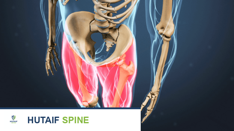 توضيح يظهر ألمًا في منطقة الفخذ والأرداف مميزة باللون.