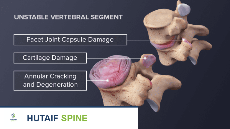الأسباب الحقيقية لآلام تنكس القرص الغضروفي: دليل شامل من الأستاذ الدكتور محمد هطيف في صنعاء