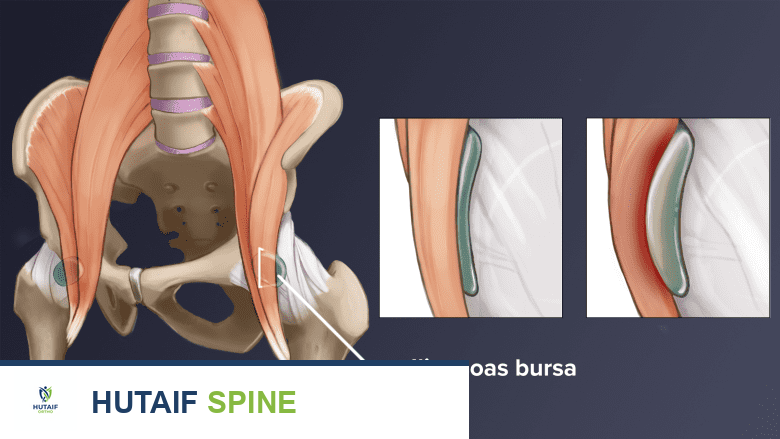 توضيح للوركين مع قسم موسع من الجراب.