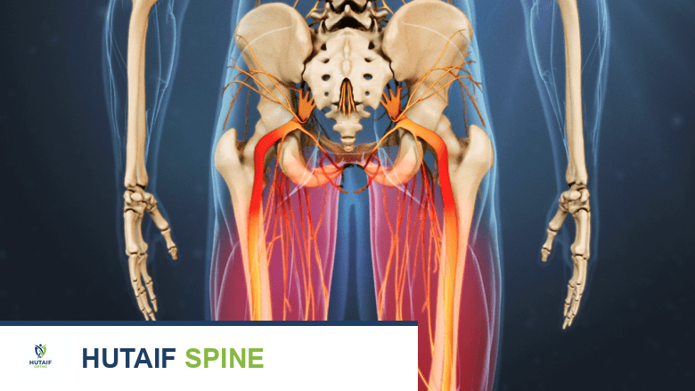 مخطط خلفي لأعصاب الساقين مع تسليط الضوء على الألم باللون الأحمر.