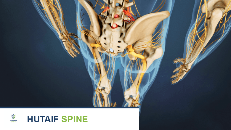 عرض خلفي لانزلاق فقاري في الساقين.