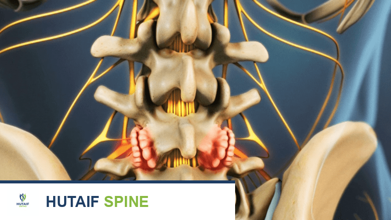 رسم توضيحي يوضح هشاشة العظام في العمود الفقري القطني