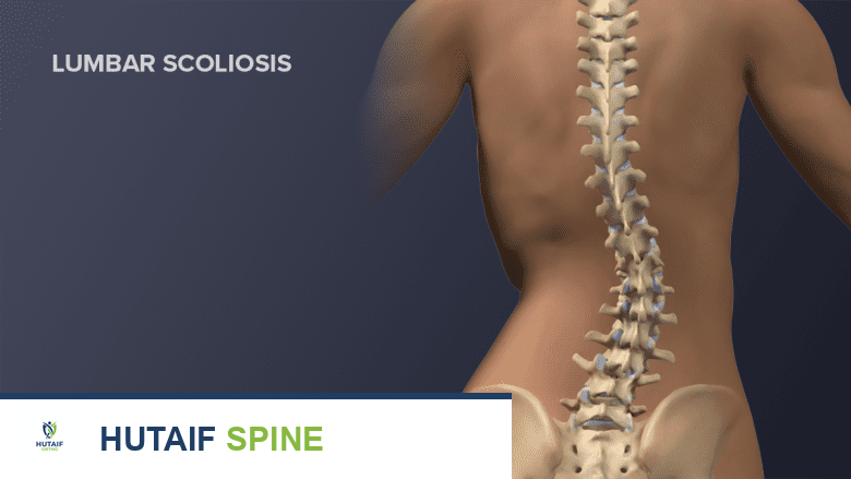 صورة توضح الجنف القطني